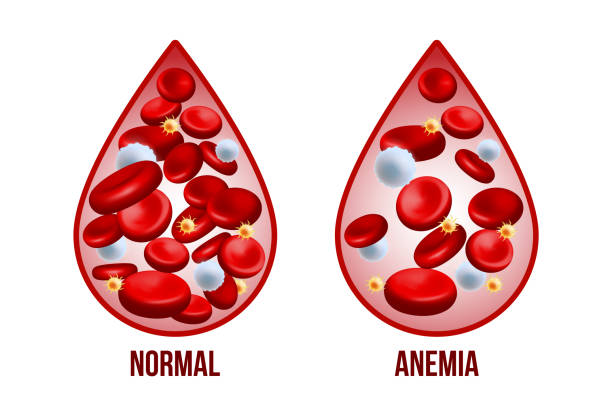 Anemia: qué es, cuáles son sus síntomas y cómo prevenirla